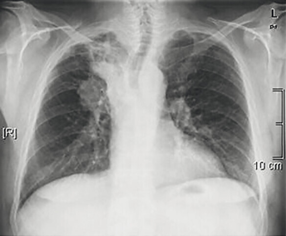 Abb.122.1aPlattenepithelkarzinom_Lungenkarzinom-Referenz-Pneumologie