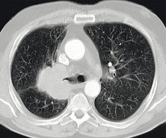 Abb.122.1bPlattenepithelkarzinom_Lungenkarzinom-Referenz-Pneumologie