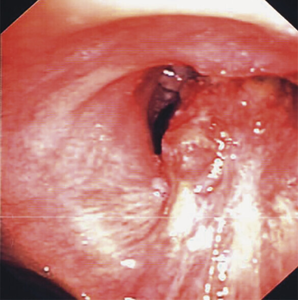 Abb.122.1cPlattenepithelkarzinom_Lungenkarzinom-Referenz-Pneumologie