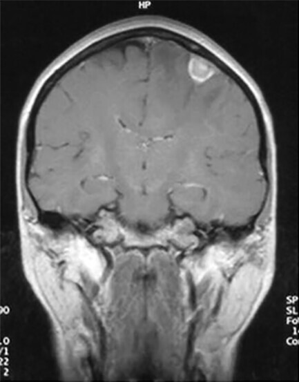 Abb.122.2aAdenokarzinom-im-rechten-Oberlappen_Lungenkarzinom-Referenz-Pneumologie
