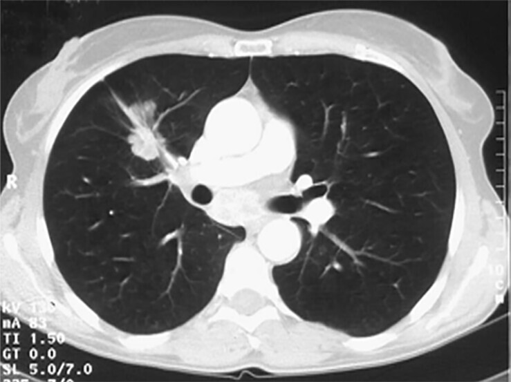 Abb.122.2bAdenokarzinom-im-rechten-Oberlappen_Lungenkarzinom-Referenz-Pneumologie
