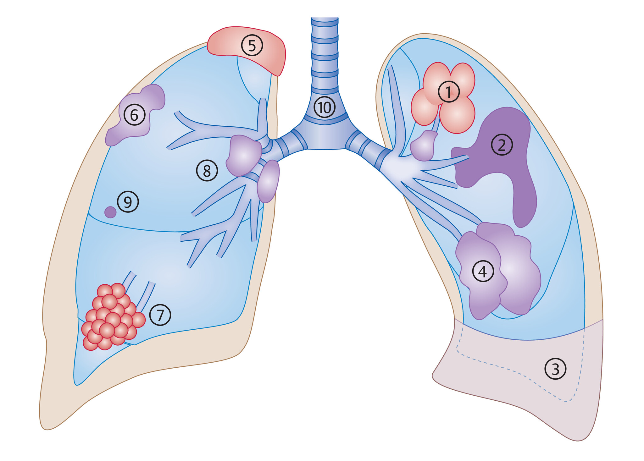 Abb.122.5Erscheinungsformen-des-Lungenkarzinoms_Lungenkarzinom-Referenz-Pneumologie
