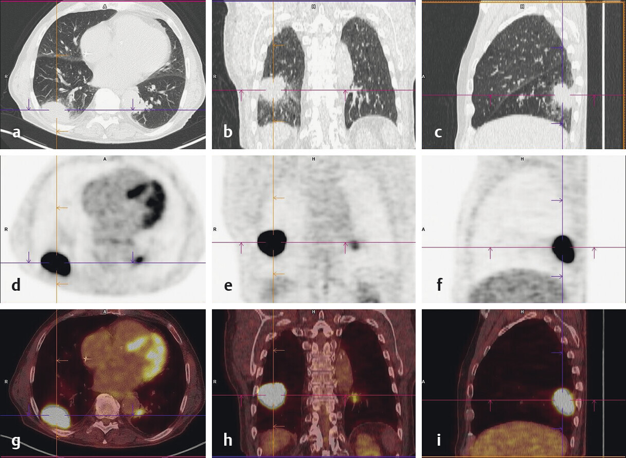 Abb.122.6Lungenkarzinom_Lungenkarzinom-Referenz-Pneumologie